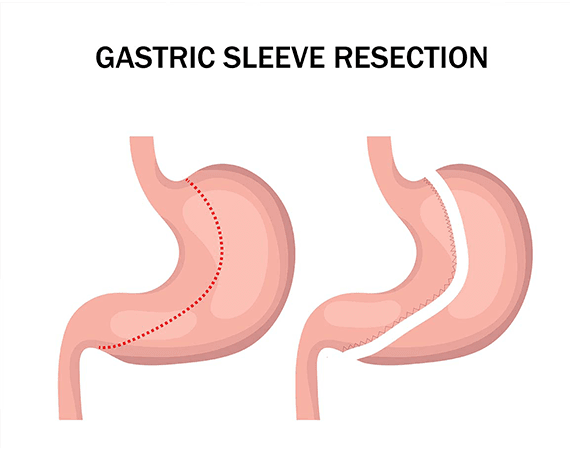 Gastrectomy Sleeve