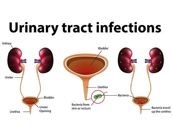 Urinary Tract Infections (UTIs)