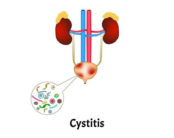 Interstitial cystitis