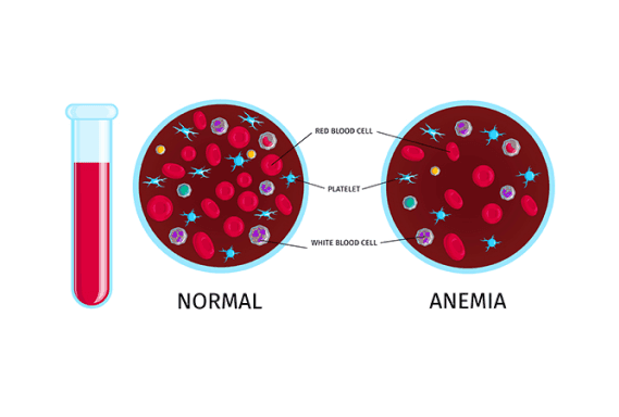 Anemia