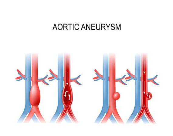 Aortic aneurysms
