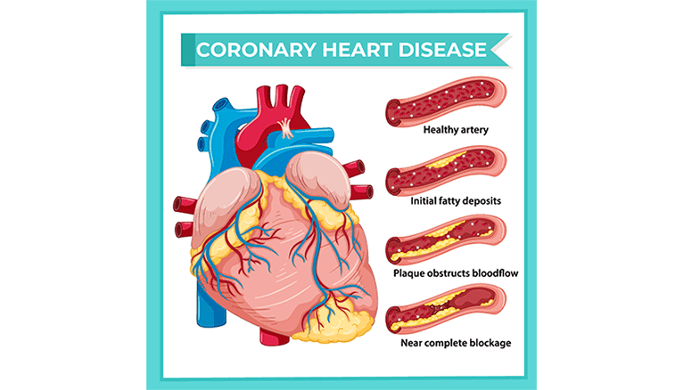 Congenital Heart Disease