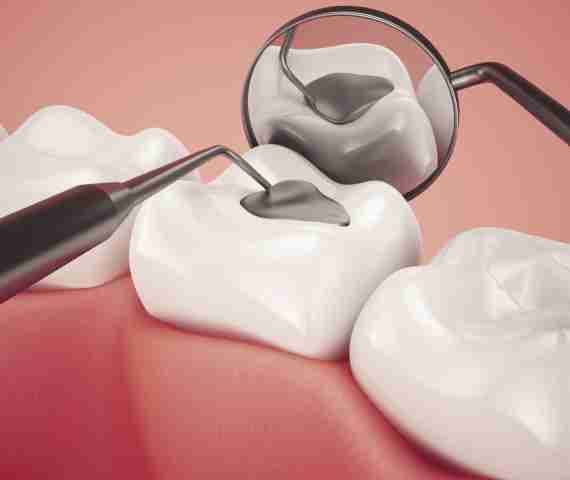 Dental Fillings