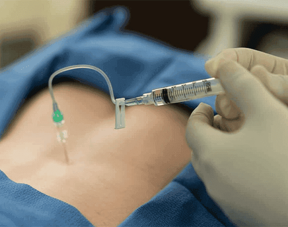 Epidural Injections