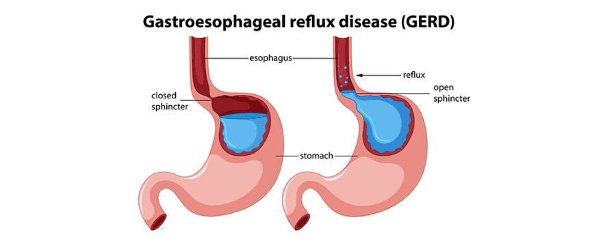 GERD | Gastroenterology | Apex Hospitals