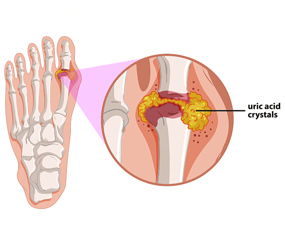 Gout 