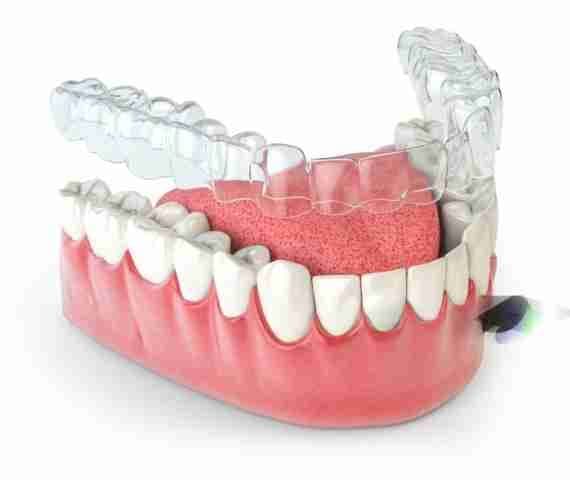 Invisalign
