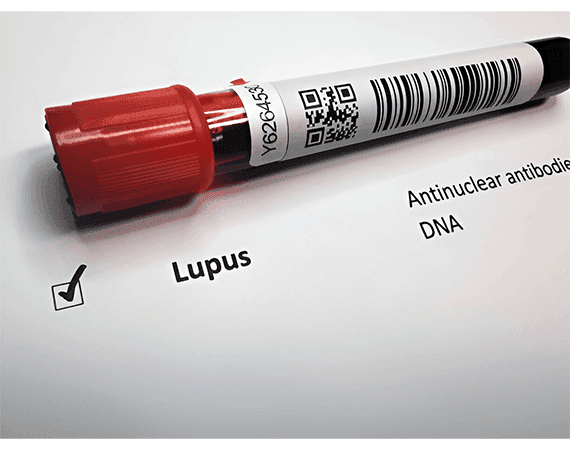 Lupus
