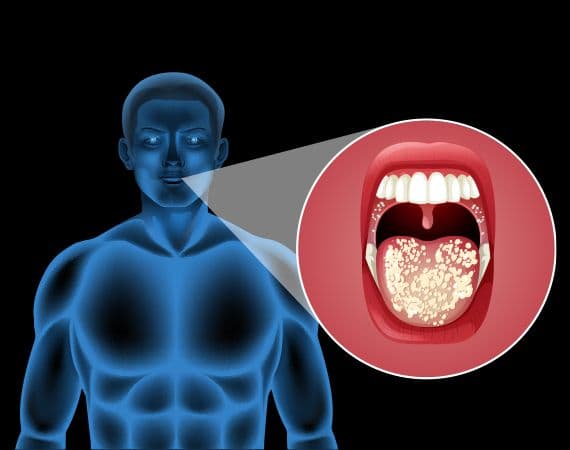 Oral Cancer