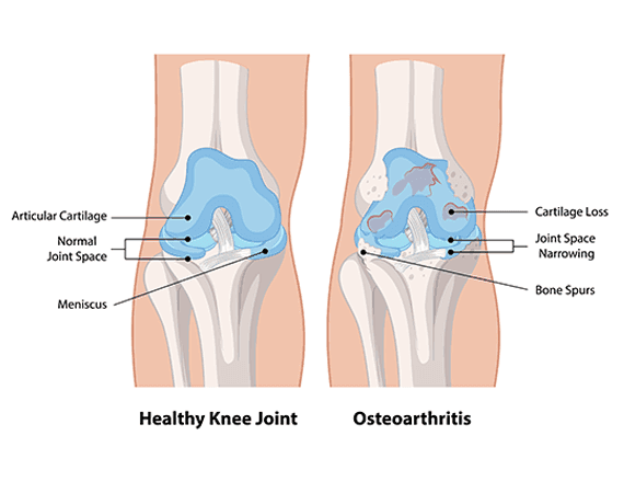 Osteoarthritis