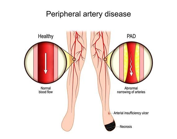 Peripheral artery disease