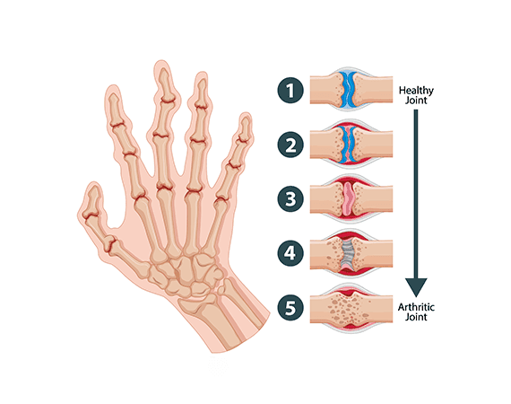Rheumatoid arthritis