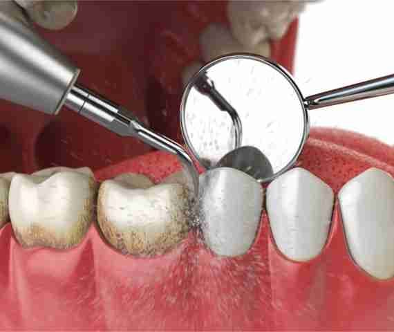 Teeth Cleaning