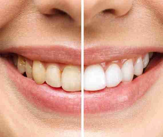 Teeth Whitening