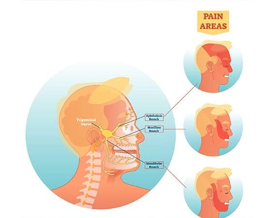 Trigeminal neuralgia surgery