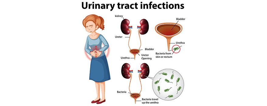 urinary tract infection