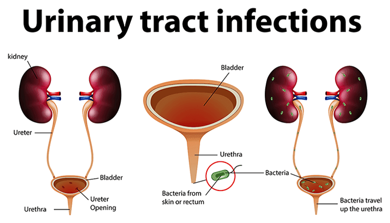 Urinary Tract Infection