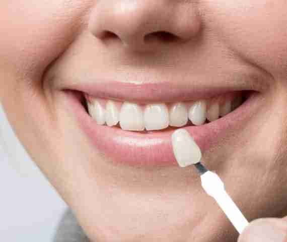 Veneers