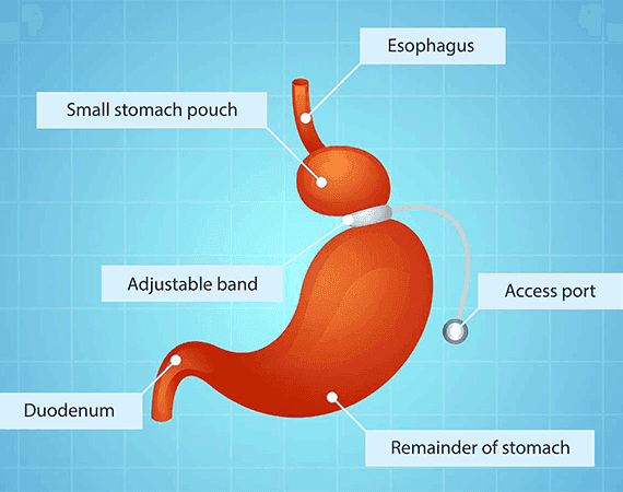 Adusjtable Gastric Band