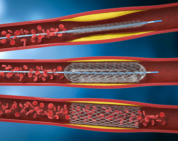 Percutaneous Transluminal Coronary Angioplasty