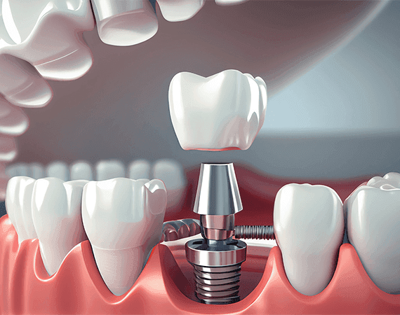 Dental Implant