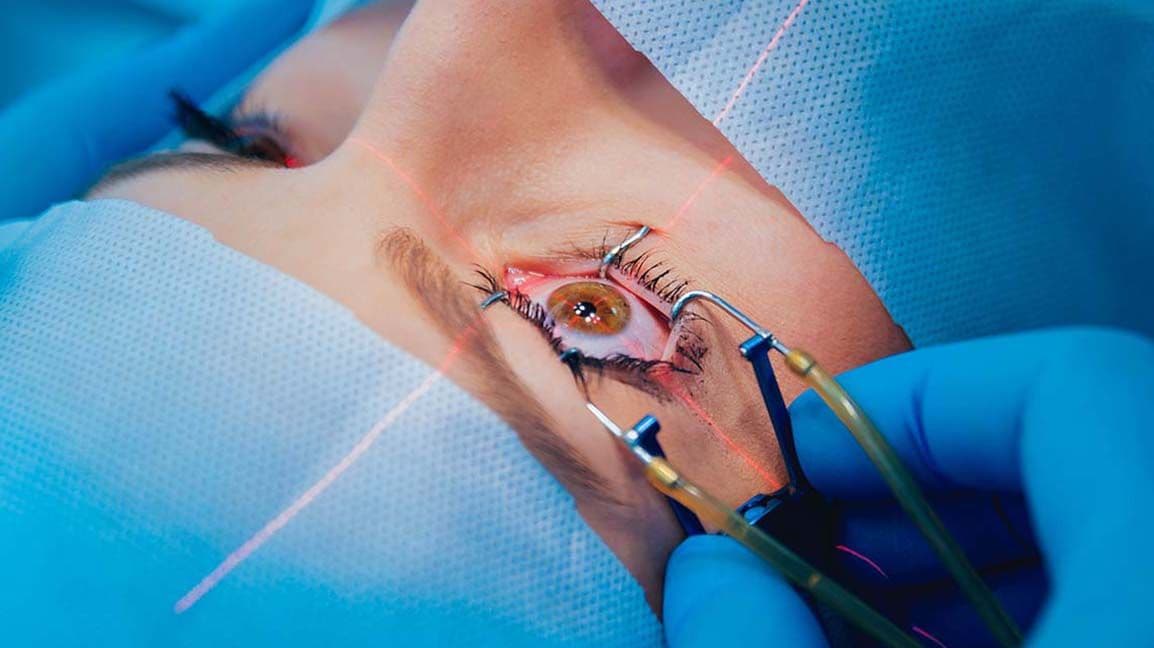 Laser Eye Surgery