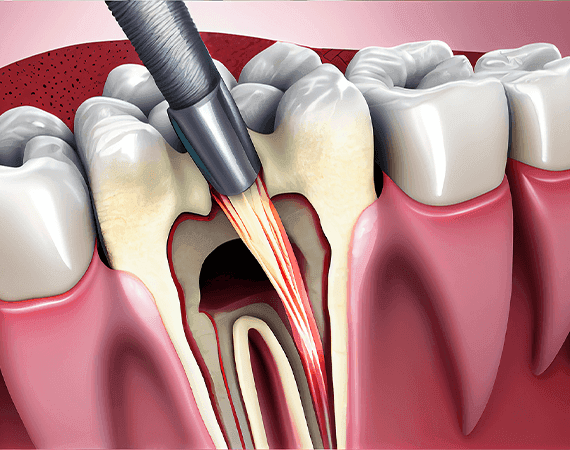 Root Canal