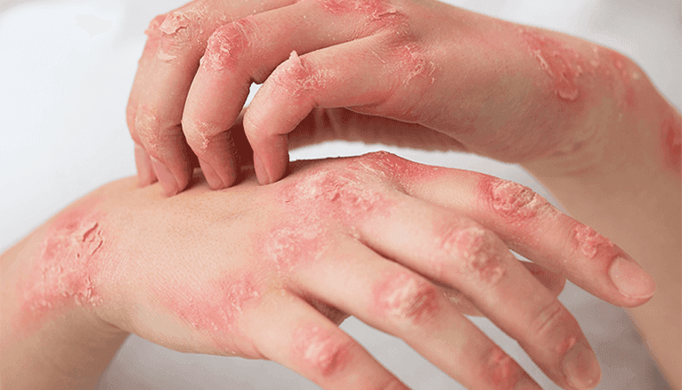 Atopic Dermatitis