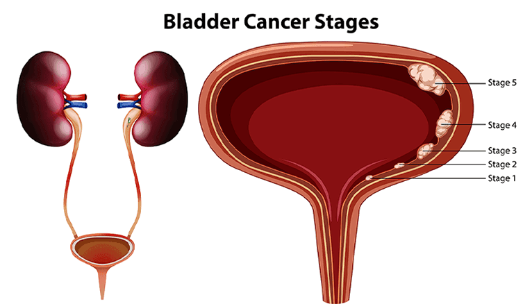 Bladder Cancer