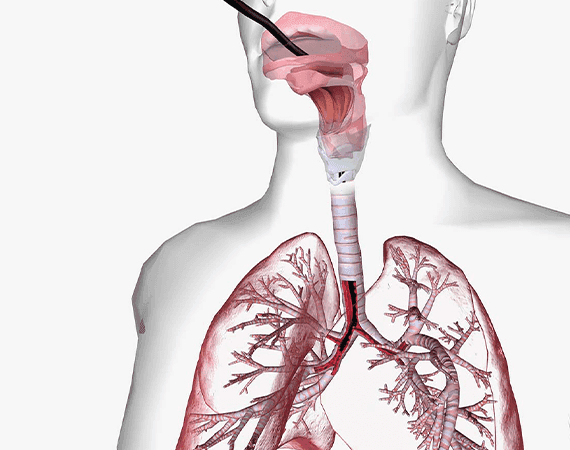 Bronchoscopy