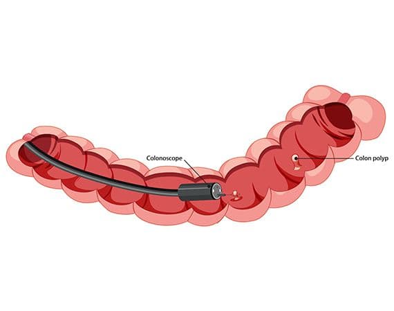 Colonoscopy