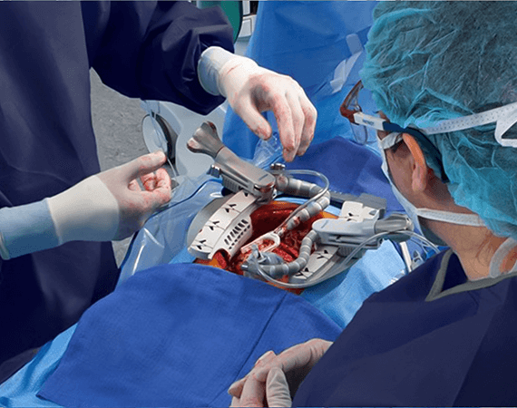 Coronary Artery Bypass Surgery