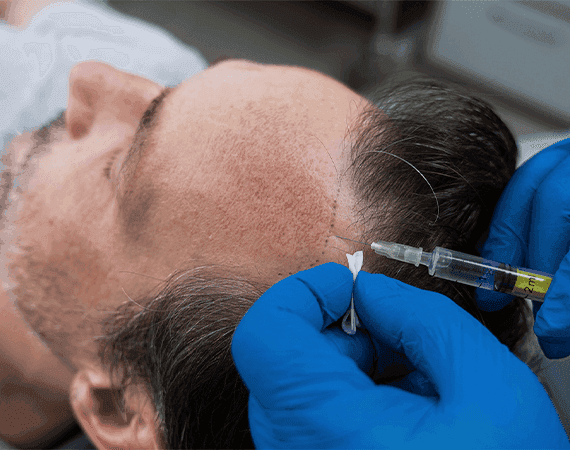Hair Transplant