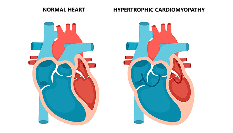 Hypertrophic Cardiomyopathy