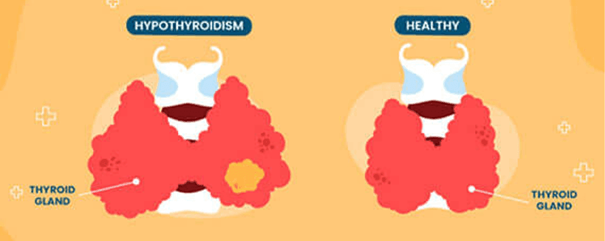 Hypothyroidism