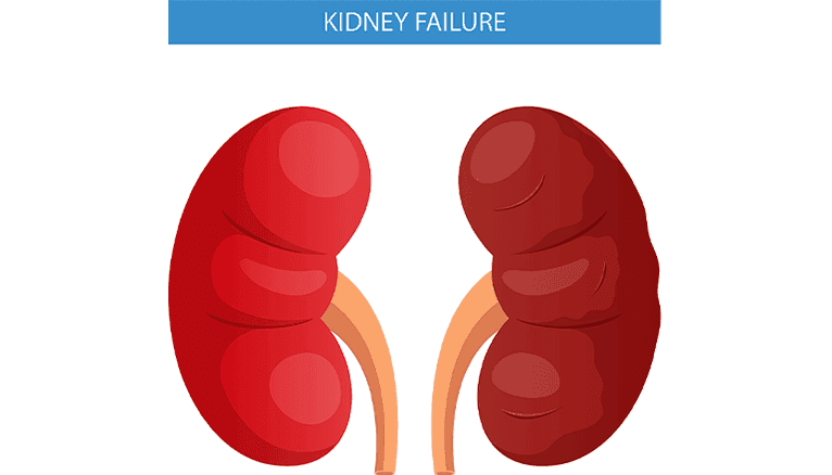 End Stage Renal Disease