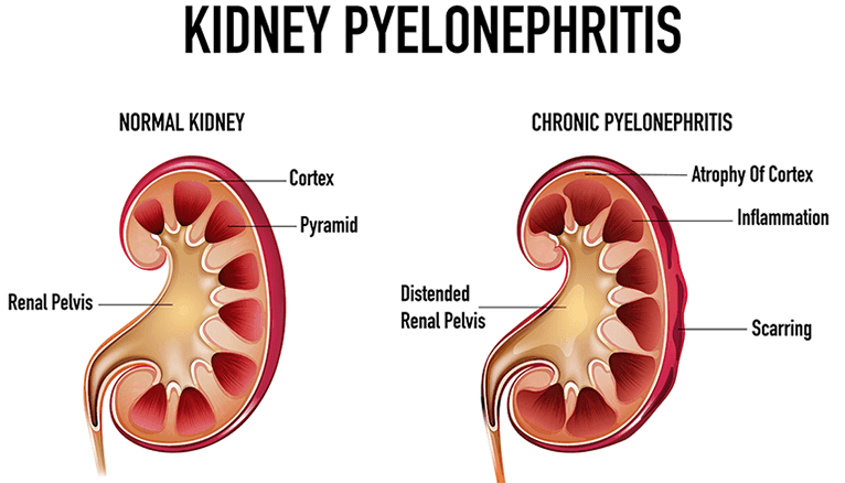 Pyelonephritis