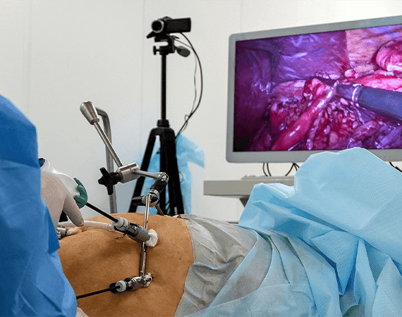 Laparoscopic surgery