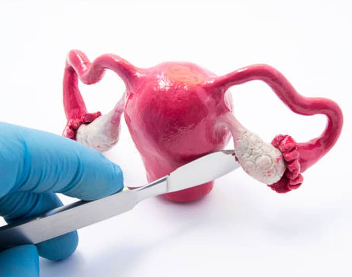 Oophorectomy