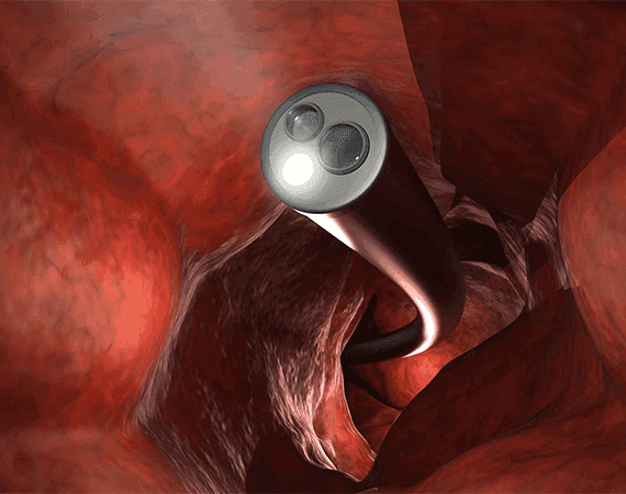 Peroral Endoscopic Myotomy