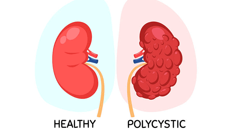 Polycystic Kidney Disease