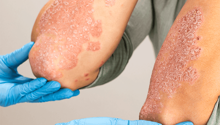 Psoriasis