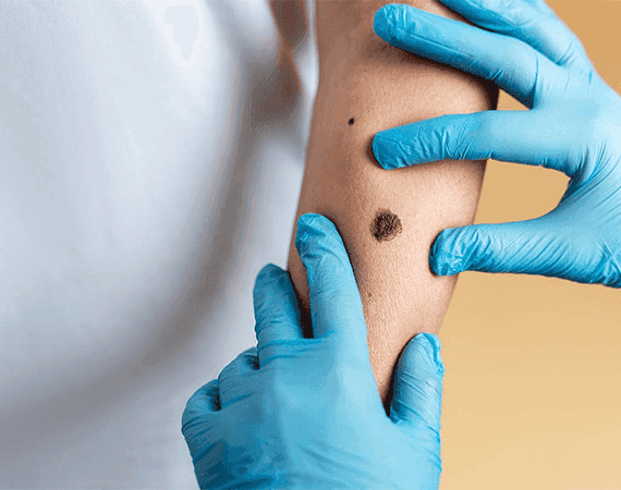 Skin Biopsy Test