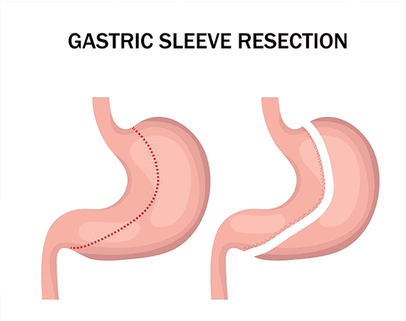 Gastrectomy Sleeve