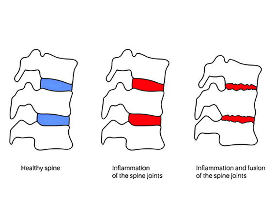 Spondyloarthropathies