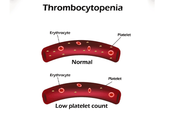 Thrombocytopenia