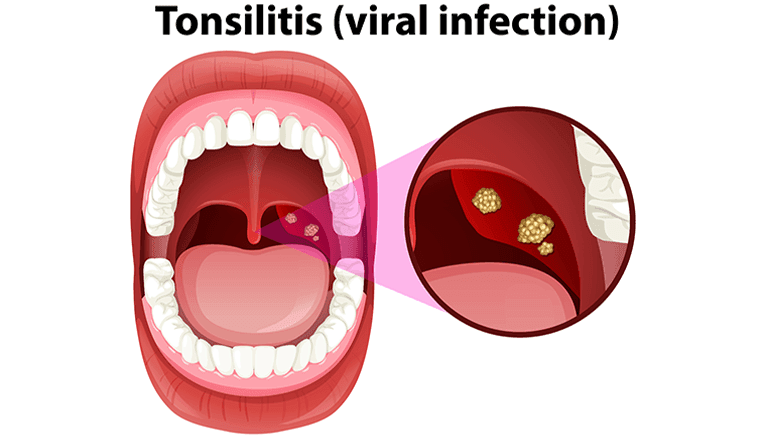 Tonsillitis