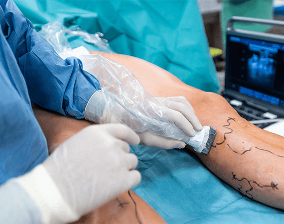 Varicose Vein Surgery